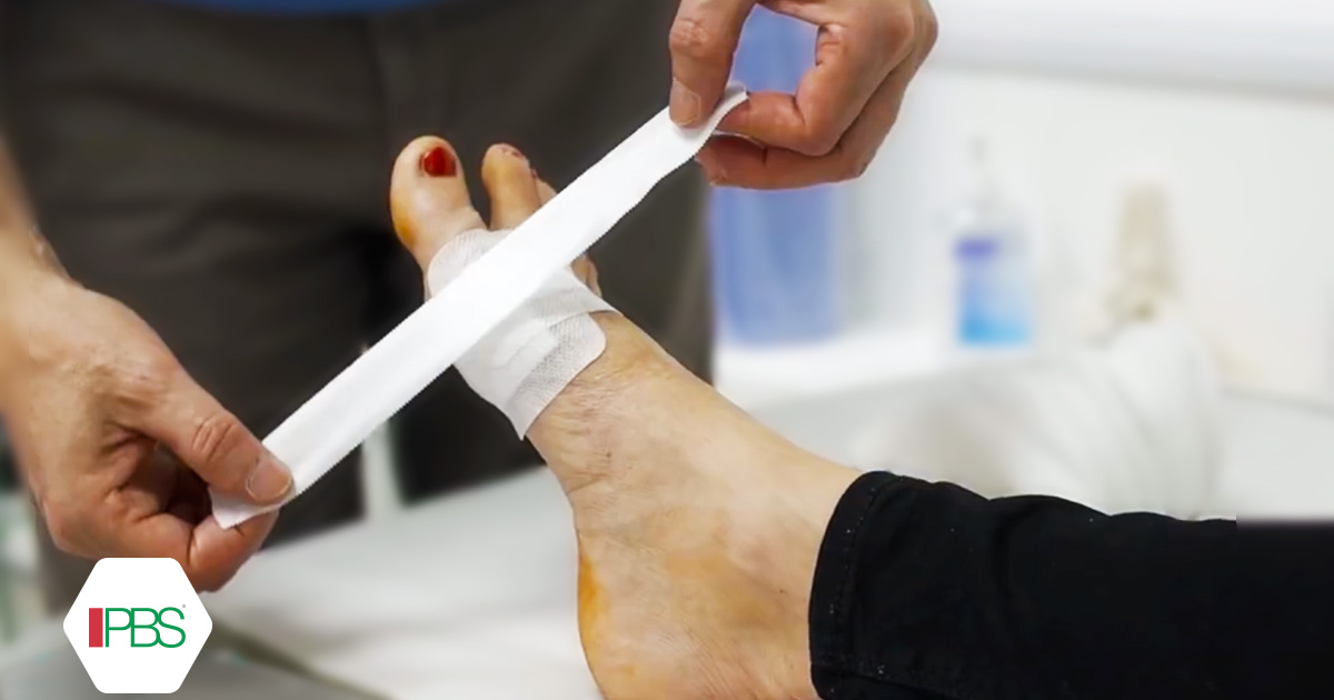 Post operatorio alluce valgo